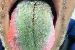 La lengua de un hombre se volvió verde y &#039;peluda&#039;