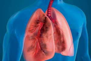 Así esta la situación de la tuberculosis en Ecuador.